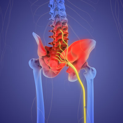 Sciatica-Chiropractor-Your-Path-to-Pain-Relief