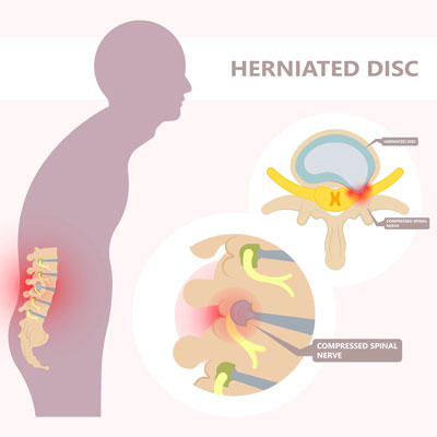 Signs Your Herniated Disc Is Healing